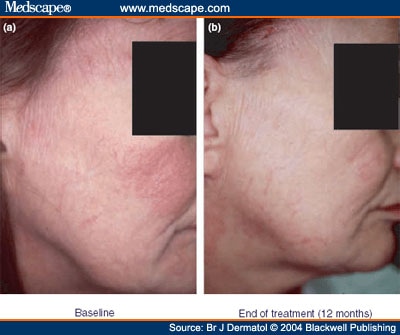 (b) Reversal of skin atrophy after treatment with tacrolimus ointment.