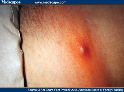 spider bites pictures and symptoms. spider bite pictures and