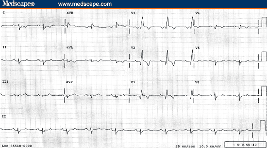 Anteroseptal Infarction