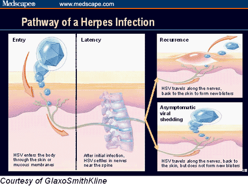 alternative-cure-for-herpes