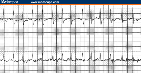 Regularly Irregular Rhythm