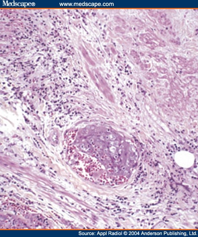 bartholin gland cyst. Bartholin+gland+cyst+treatment Severity of pics of being a that feb