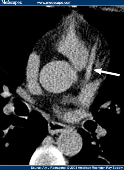 Coronary Artery Calcium Scoring