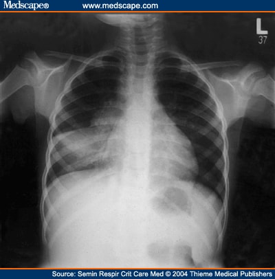 tuberculosis x ray. A chest x-ray from a young