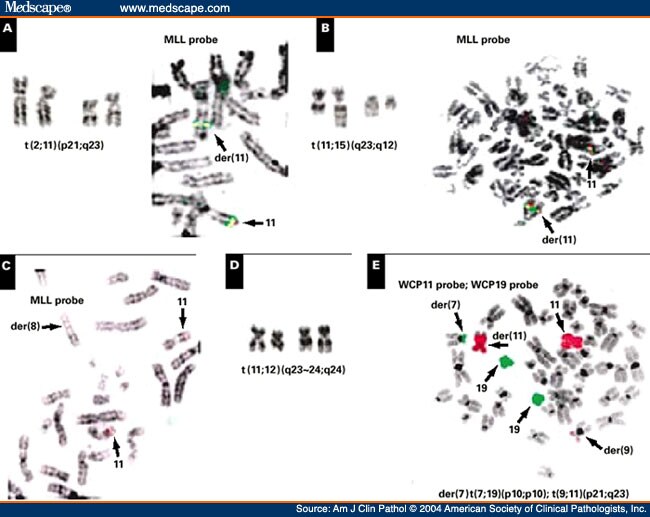 Mll Gene