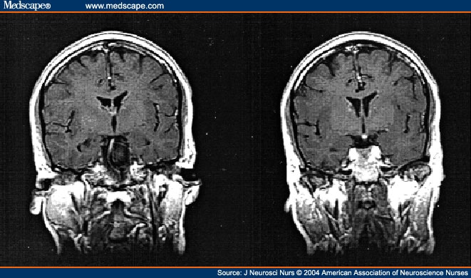 mri brain scan. imaging (MRI) scan with