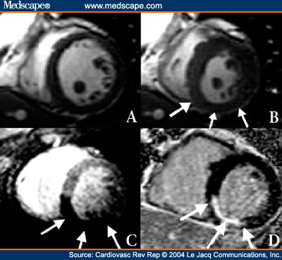 cine mri