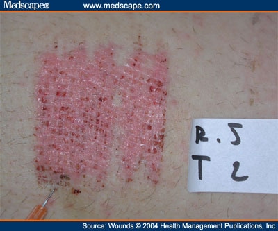 Skin Graft Donor Site & Use Of PDRN