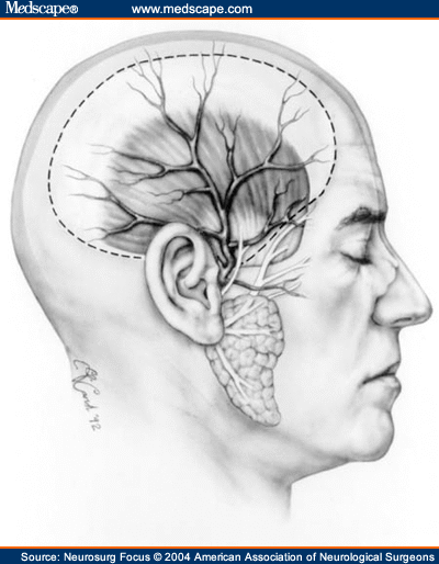 Temporal Fascia