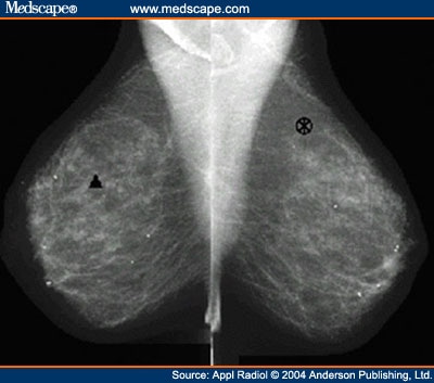 Normal Mammogram Image