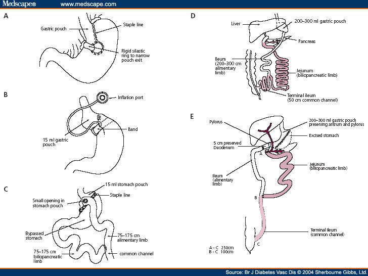 Bariatric Surgery Types