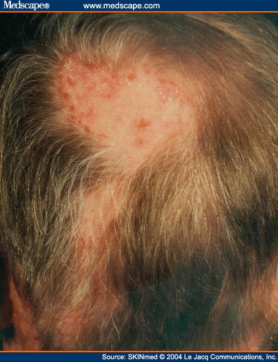 Hair Follicle Diseases Leading to Hair Loss: Scarring ...