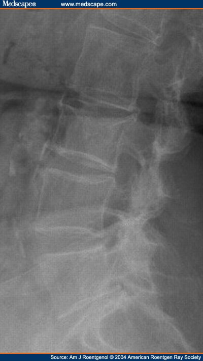 vertebral wedge fracture
