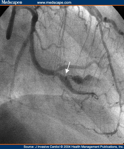 Coronary Artery Dissection And Perforation