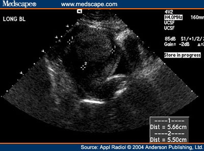 Uterine Fibroids On Ovaries | Fibroids Treatment