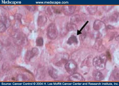 A Case of Spitzoid Melanoma - PubMed Central (PMC)