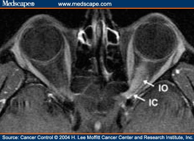 Orbital Meningioma