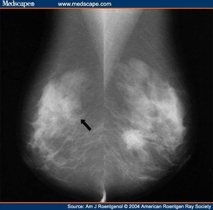 Digital Mammography: The Promise of Improved Breast Cancer Detection