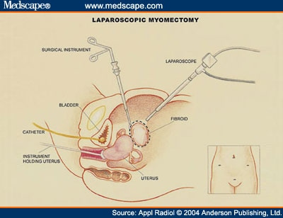 Uterine artery embolization: Part 2: Other Therapeutic Options 