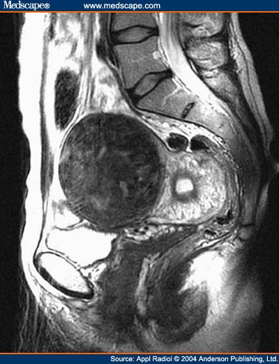 Removal Of Fibroids