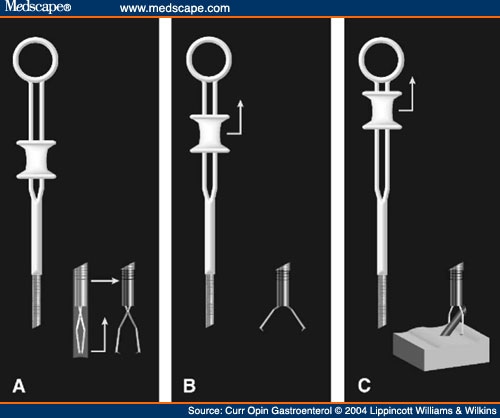 Suggested hemoclipping technique (A) Removing the external sheath. (B 