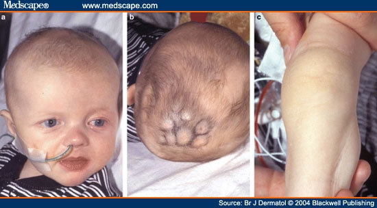 gorlin syndrome pictures