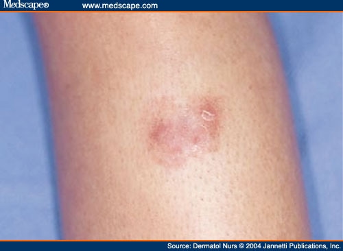 spider bites symptoms and pictures. spider bites images.