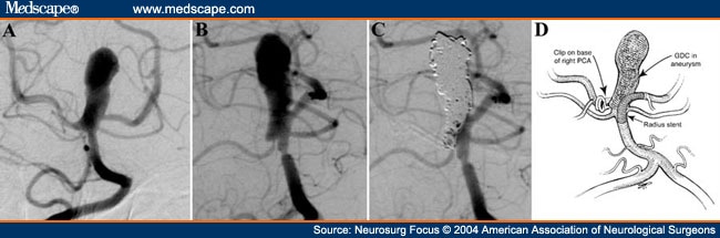 aneurysm clipping. basilar apex aneurysm.