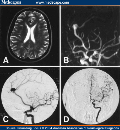 of the rain revealing a saccular aneurysm brain. of the rain revealing a
