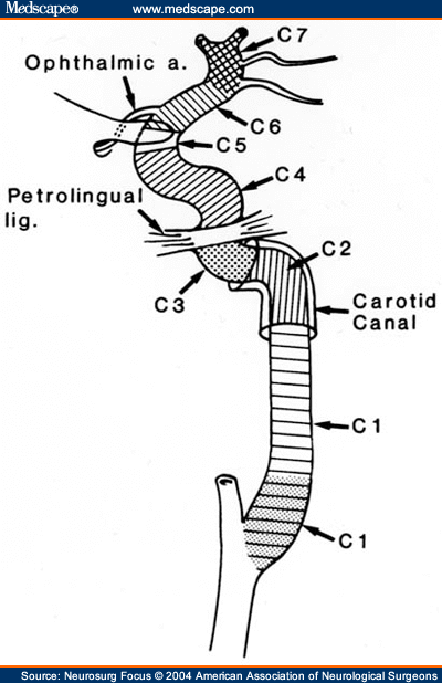 Lateral anatomical diagram depicting the seven ICA segments.