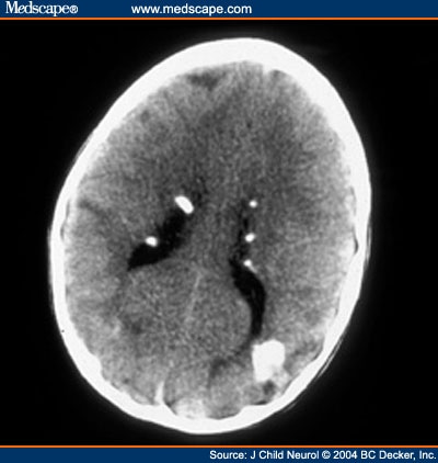 Tuberous Sclerosis; Bourneville Disease; Epiloia; Phakomatosis, Bourneville