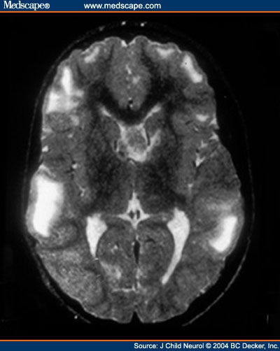 Tuberous Sclerosis; Bourneville Disease; Epiloia; Phakomatosis, Bourneville