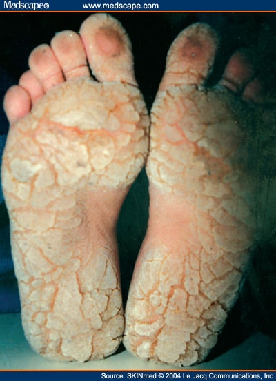 Psoriasis - Wikipedia