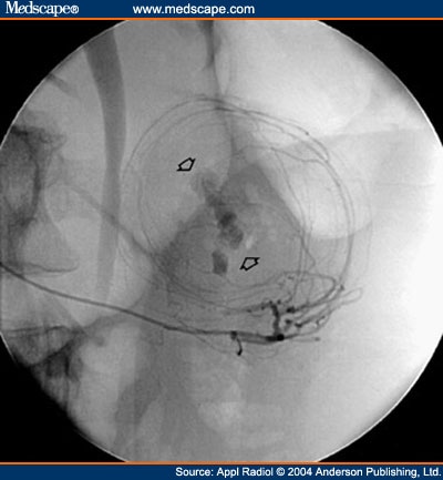 Mallinckrodt Catheter