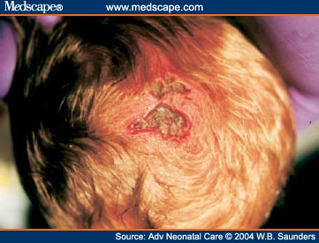 Cutis Aplasia Scalp