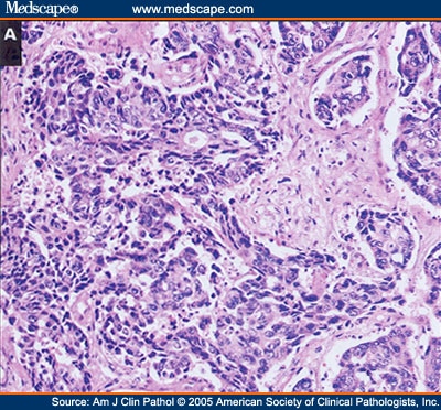 Poorly differentiated enteric-type adenocarcinoma of the colon showing 