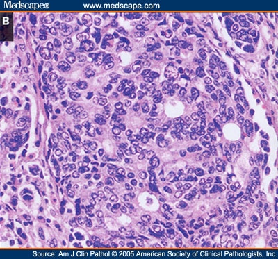 Poorly differentiated enteric-type adenocarcinoma of the colon showing 