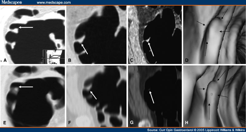 Lung Polyps