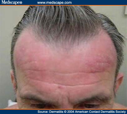 forehead rash pictures