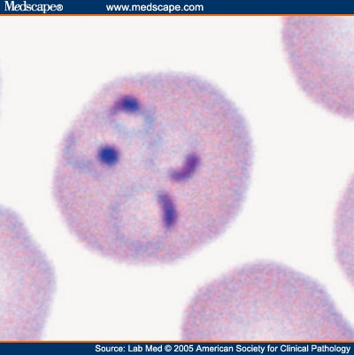  (D) a non-enlarged multiply infected red blood cell with 