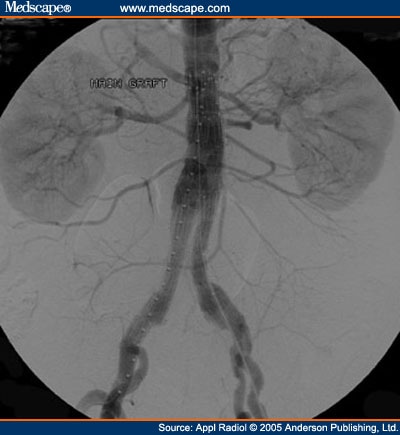 Zenith stent graft. 2011