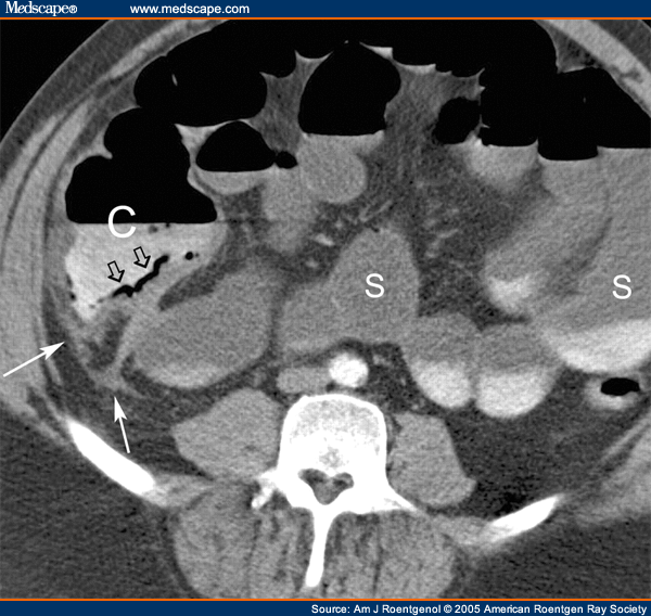 Helical Ct Evaluation Of Acute Right Lower Quadrant Pain