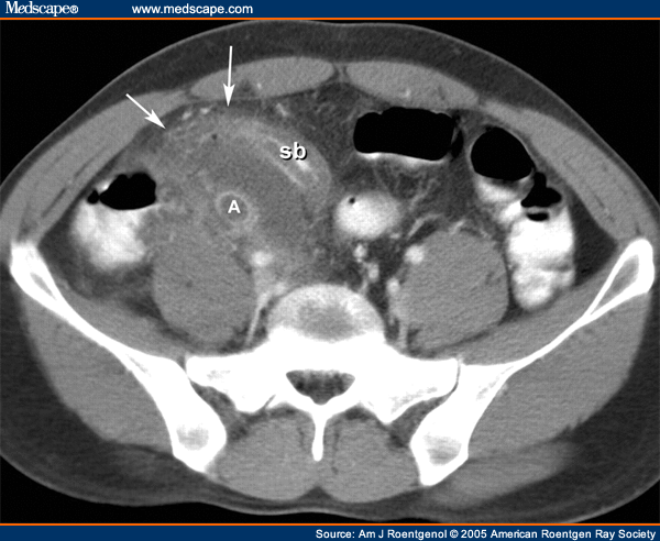 Appendix Ct Scan