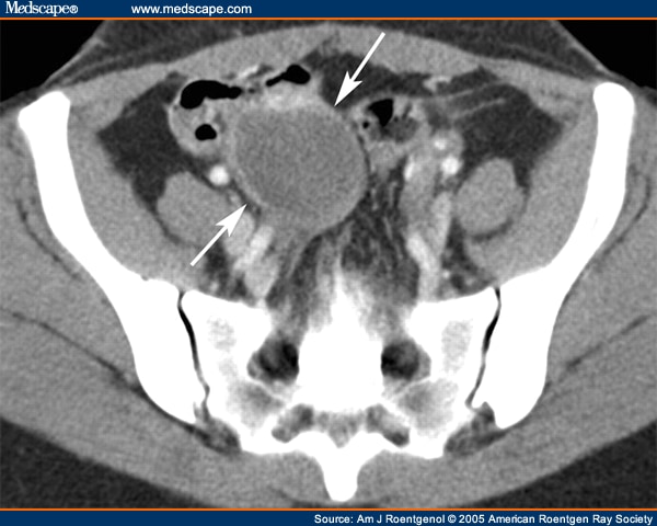 Ruptured Ovarian Cyst. Hemorrhagic Ovarian Cyst