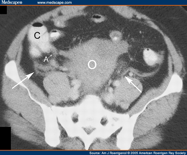 Appendix Ovary