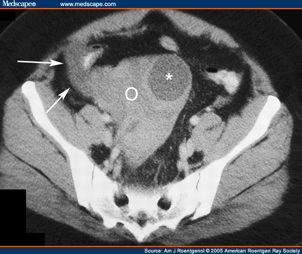 Helical Ct Evaluation Of Acute Right Lower Quadrant Pain 2