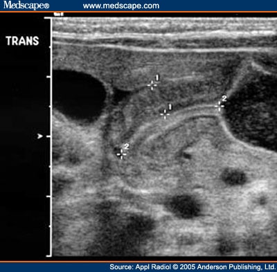 Hypertrophic pyloric stenosis. Long-axis view through the hypertrophied 