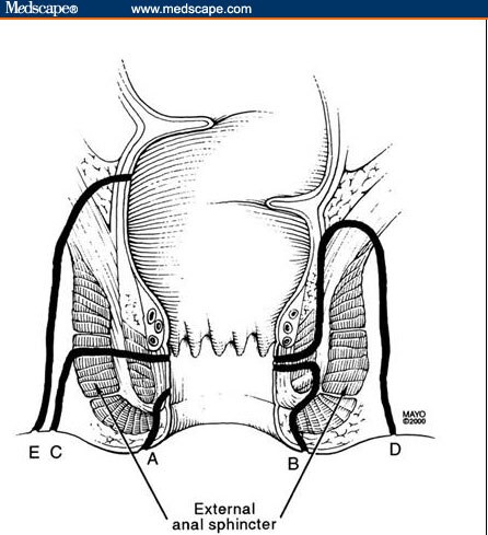 Superficial anal fistula