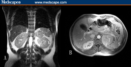 Adrenal Tumour