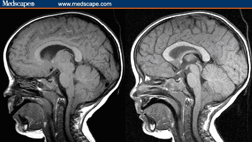 herniation of brain. MRI of rain showing findings